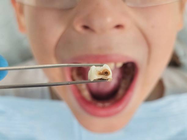 Best Emergency Treatment for Dental Infections or Abscesses in Covington, TN