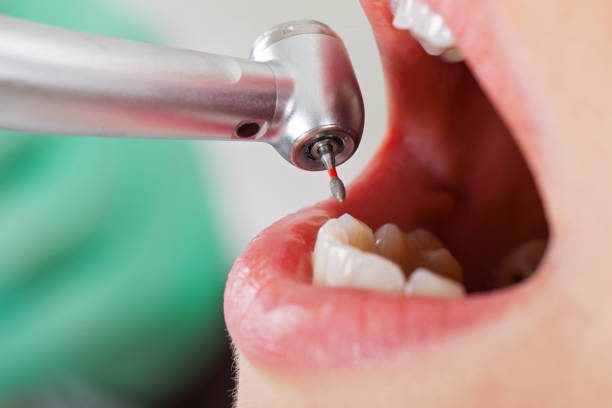 Best Urgent Care for Lost Fillings or Crowns in Covington, TN